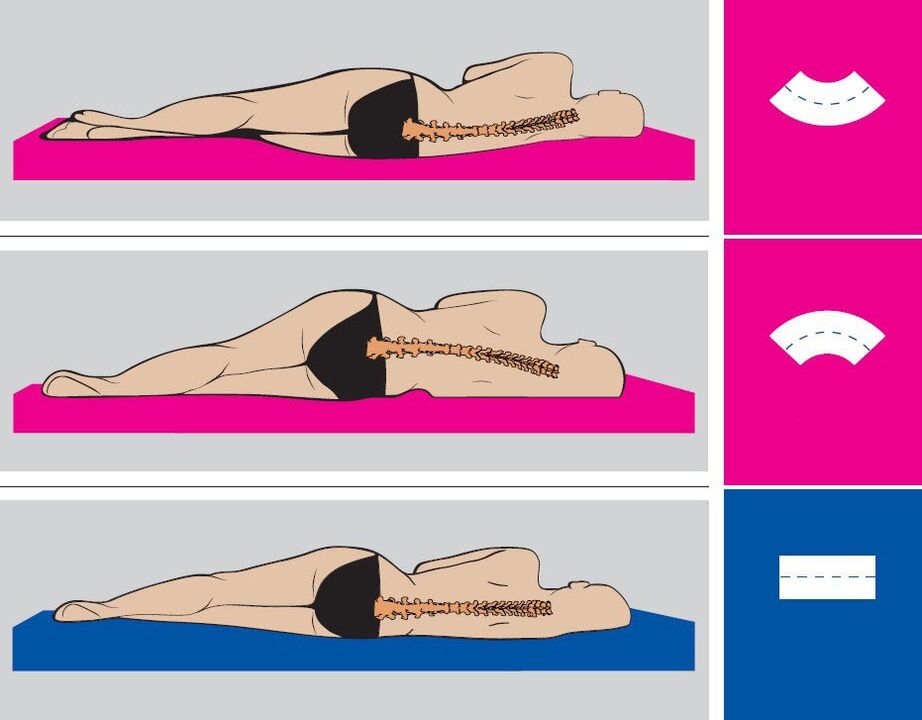 Pareiza ķermeņa pozīcija miega laikā ar jostas daļas osteohondrozi