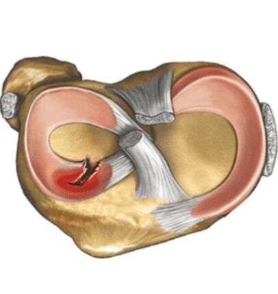Meniska trauma