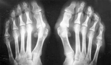 artrīta un artrozes simptomu diferenciāldiagnoze