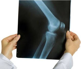 Ceļa locītavas artrozes rentgens