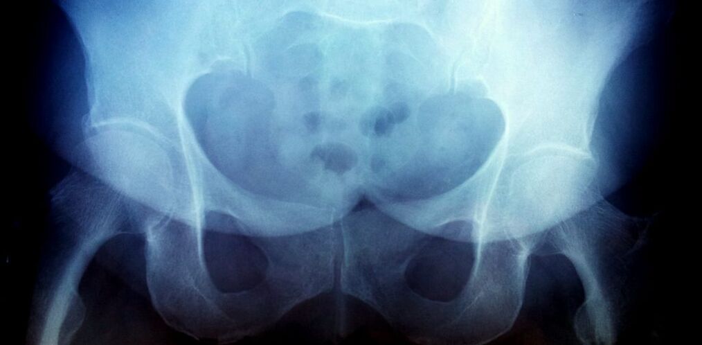 X -Ray attēls ar 2. pakāpes artrozi